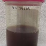 Hematúria (urina com sangue)